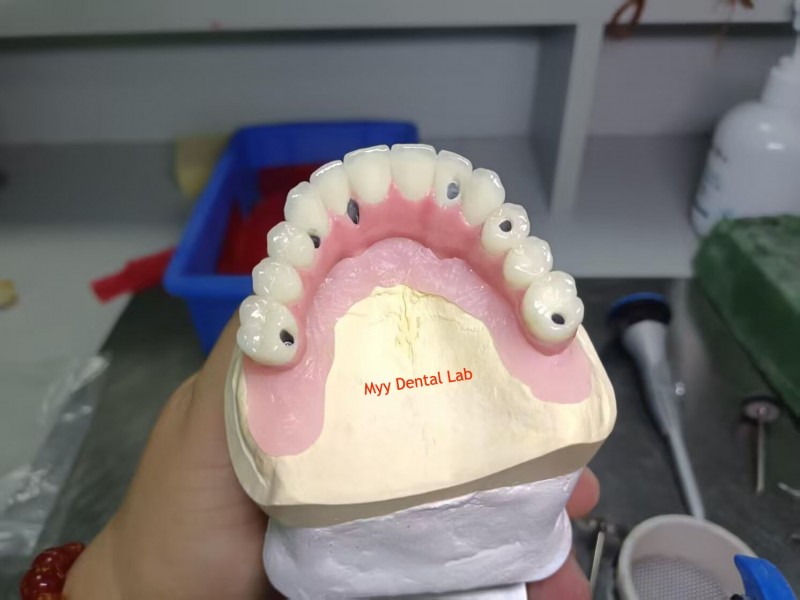 Lower Dental Implants