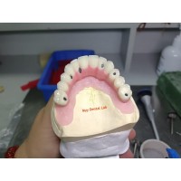 Lower Dental Implants